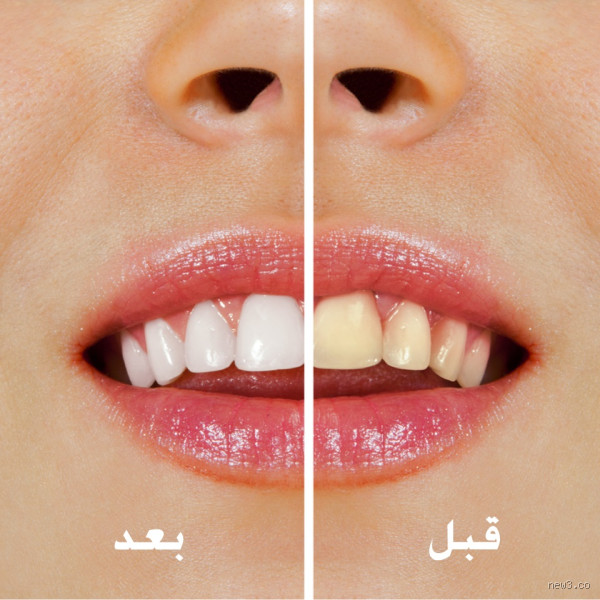 ما هي أسرع طريقة لتبييض الأسنان؟ اكتشف الحلول الفعالة