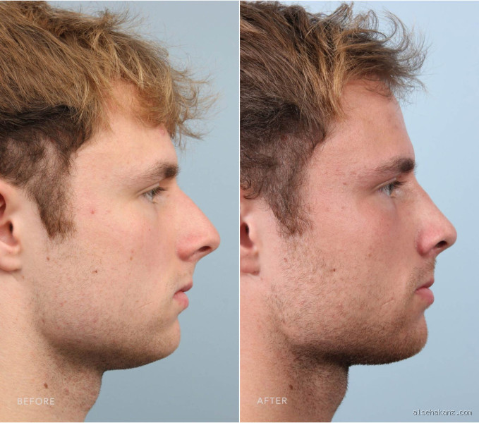 هل هناك أحد مات أثناء عمليات تجميل الأنف؟ الحقائق التي يجب أن تعرفها