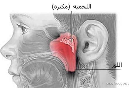 هل اللحمية لها أضرار؟ اكتشف كل شيء عن هذا الموضوع المثير