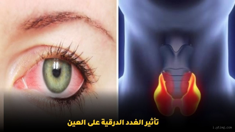 هل نشاط الغدة الدرقية يسبب جفاف العين؟ اكتشف العلاقة