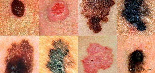 هل سرطان الجلد يظهر في فحص الدم؟ مفاجآت قد لا تعرفها!