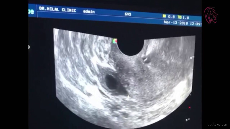 هل يمكن أن تحمل الطفلة؟ الحقيقة المدهشة وراء هذا السؤال