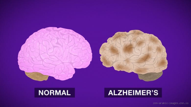 هل يمكن أن تتحول العضلات إلى دهون؟ الحقيقة وراء هذا المفهوم