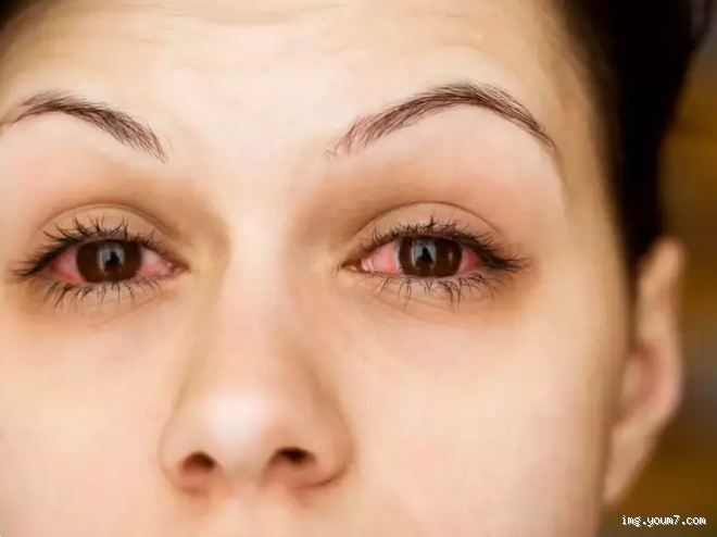 كم تستمر أعراض إجهاد العين؟ تعرف على الإجابة هنا