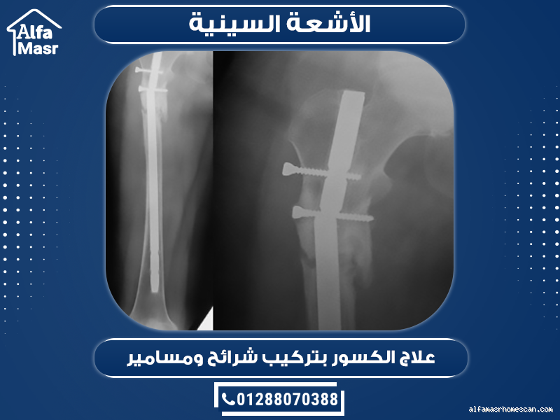ما هو بديل الشرائح والمسامير؟ حلول جديدة لعلاج الكسور بدون جراحة تقليدية
