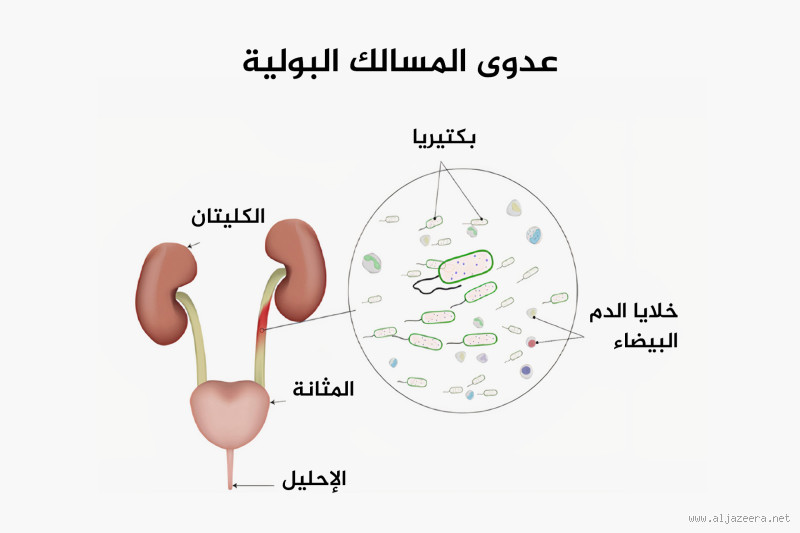 ما هي أعراض انسداد المسالك البولية؟