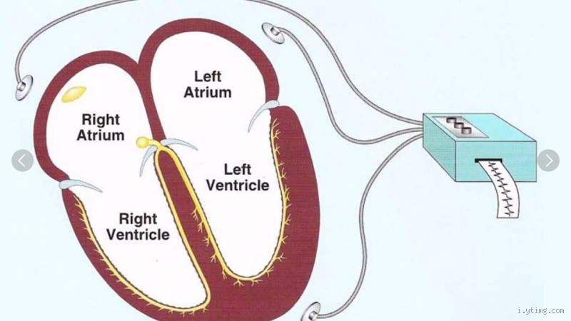 ماذا يعني T في تخطيط القلب؟