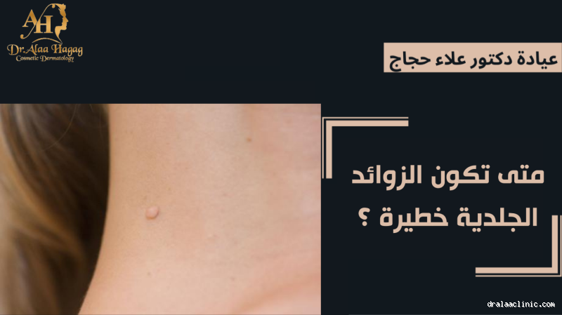 متى تكون الزوائد الجلدية خطيرة في المهبل؟ تعرفي على أهم التفاصيل