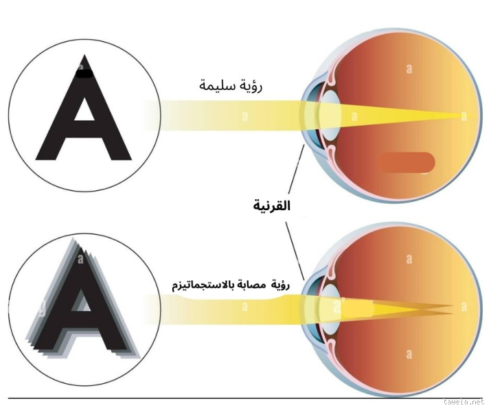 متى يتوقف الاستجماتيزم؟ الحقيقة اللي محدش بيقولها